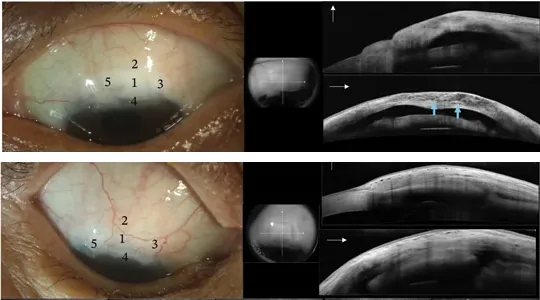Two human eyes after trabeculectomy with cataract surgery, each shown in a slit-lamp photograph and two OCT scans: above, a functioning filtering bleb; below, a non-functioning one.