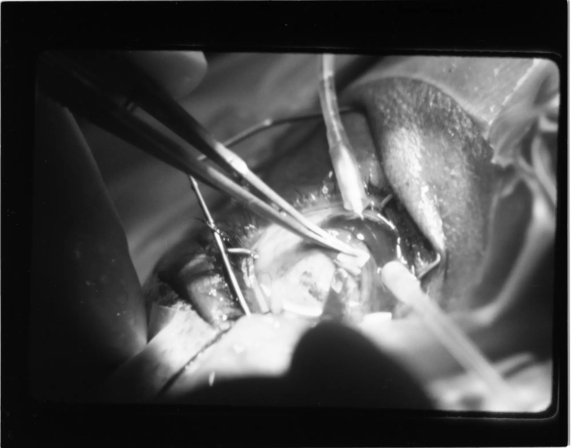 Black-and-white photograph of glaucoma surgery under an operating microscope in 1978.